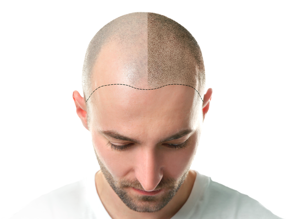 Hair transplant men New Jersey