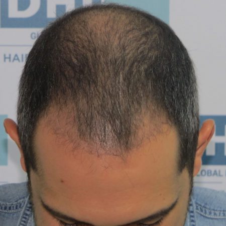 Resultado de Transplante de Cabello - Norwood 4