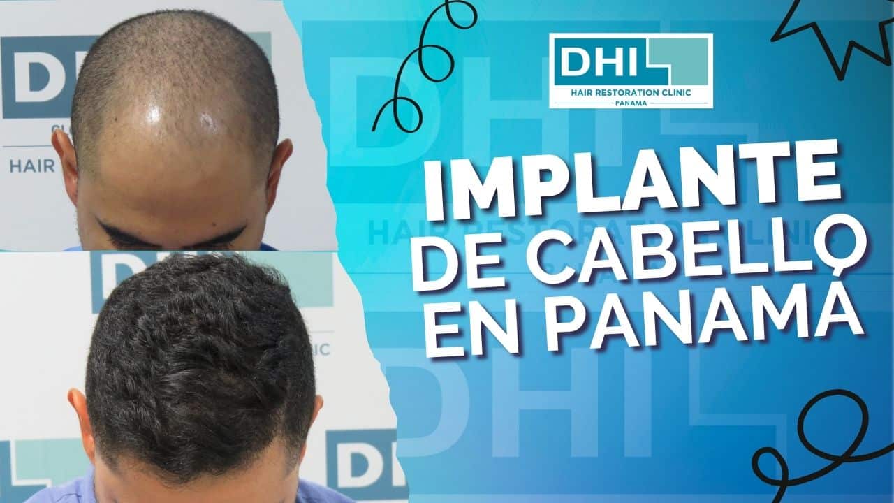 Implante de Cabello en Panamá