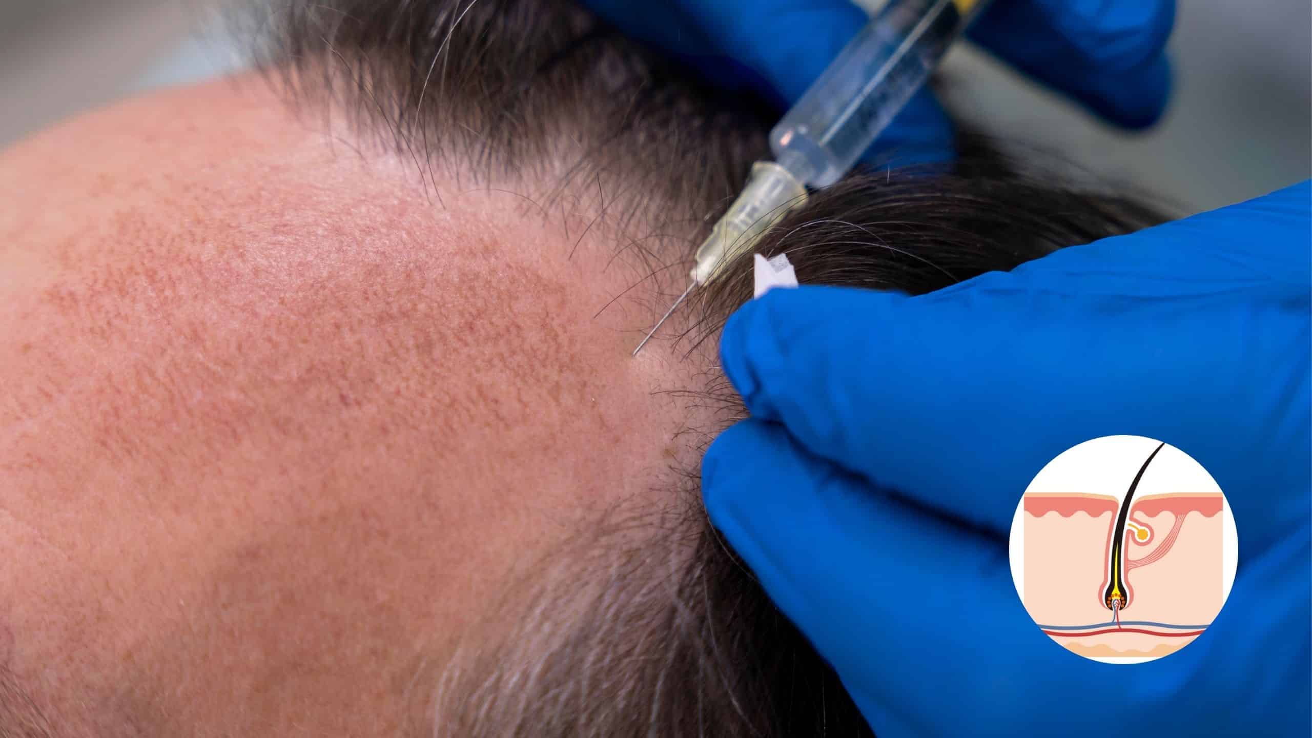 Cómo los Exosomas Estimulan el Crecimiento del Cabello